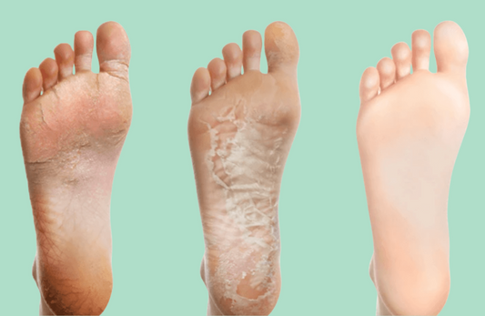 Comment le peeling pour pieds va enfin résoudre vos problèmes ?